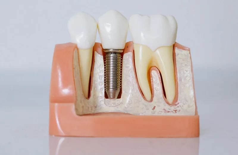 Dental Implants